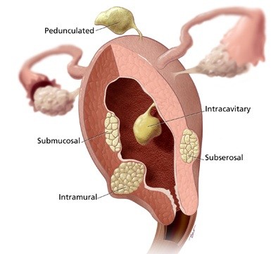 fibroid womb uterine