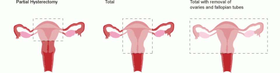 Different types of hysterectomy